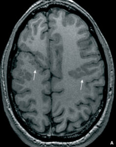 Questa immagine ritrae una persona con una malformazione cerebellare che sta sottoponendosi a un esame di NeckTC Si vede la sua testa, il suo viso e il suo collo