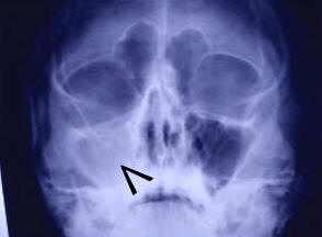 Una persona affronta linfertilità con diversi esami, tra cui unecografia per visualizzare gli organi interni, una TC scan per immagini in D, una risonanza magnetica per ottenere immagini più dettagliate, e una radiografia per vedere come funziona la respirazione attraverso il naso