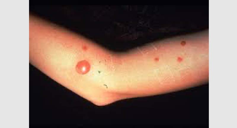 Un bambino con uninfiammazione cutanea bollosa al braccio, una parte del corpo che colpisce anche gli adulti