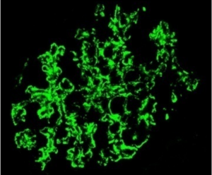 Immagine di un modello frattale di una foglia LeafVerde con accessori di luce ornamentali per evidenziare la natura esterna di una malattia renale cronica